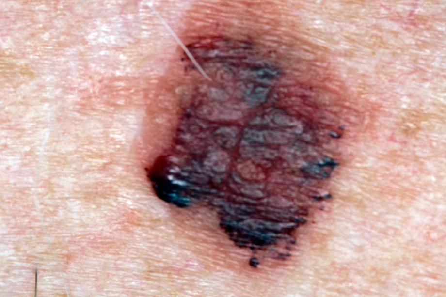 Picture of lentigo maligna melanoma