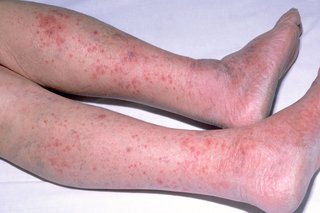 Picture of meningitis rash on legs and feet of a white-skinned child