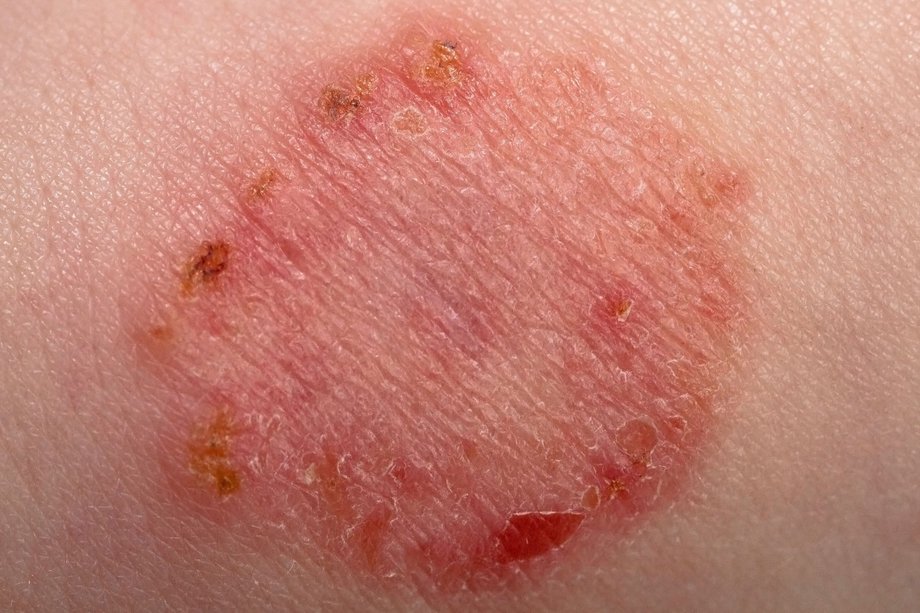 does scratching ringworm make it worse