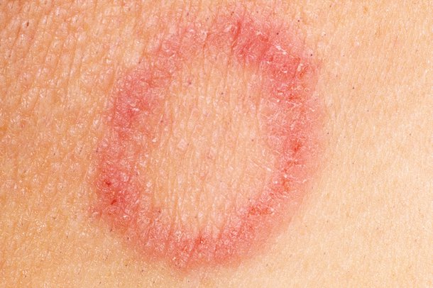 Picture of ringworm rash