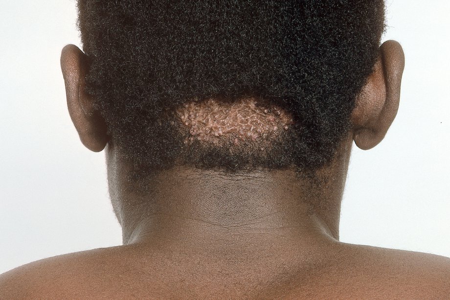 How Long Do Keloid Scars Take To Heal at sallykboydstono blog