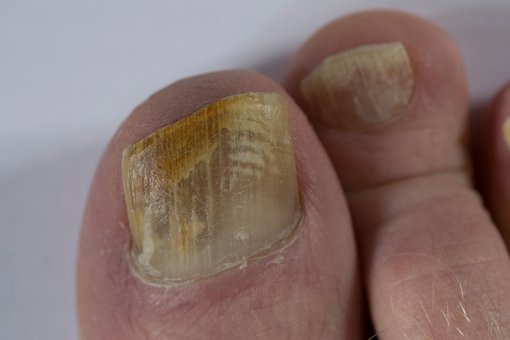 A fungal nail infection that's spread across a whole toenail.