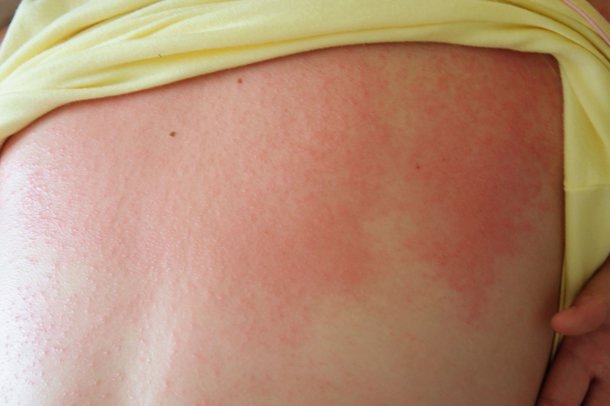 Heat rash on the back