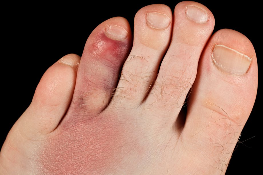 How Can You Tell If You Fractured Your Toe