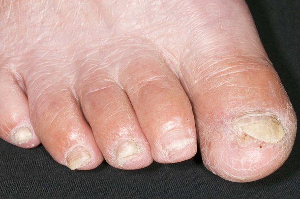 A fungal nail infection