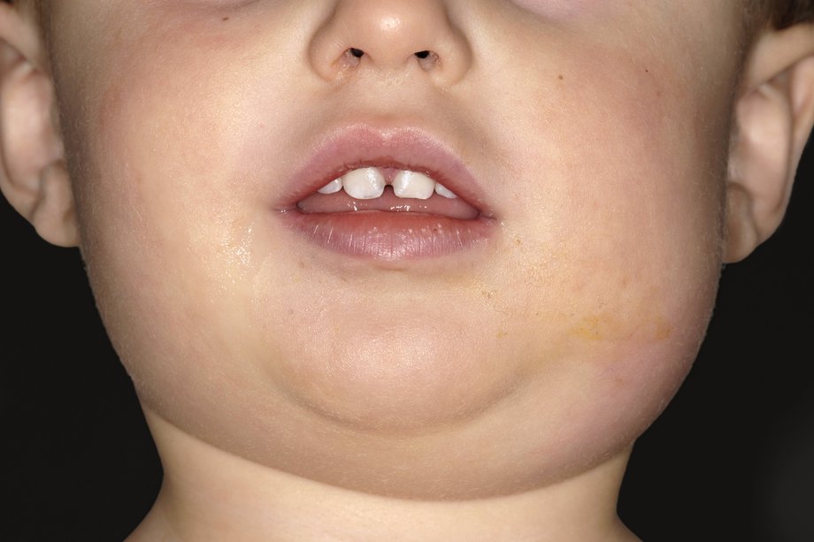 Picture of a child with mumps