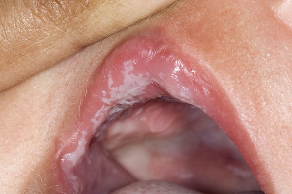 Picture of thrush in a baby's mouth