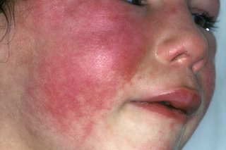 A red, patchy rash on a young child's face