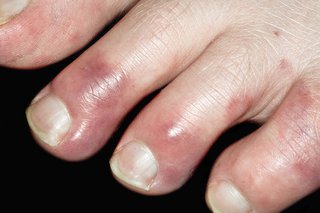 Chilblains on toes