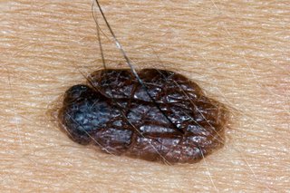 A harmless raised mole with hair growing from it