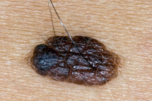 Sometimes they have hair growing from them Image Credit: DR P. MARAZZI/SCIENCE PHOTO LIBRARY