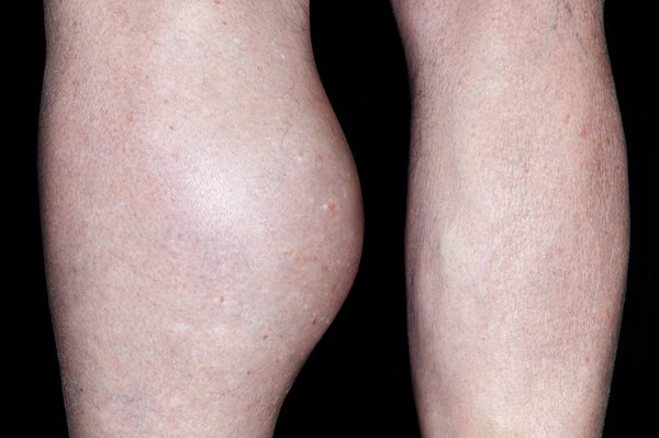A Baker's cyst on a leg
