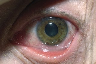 A herpes simplex eye infection can cause the eye to redden and swell