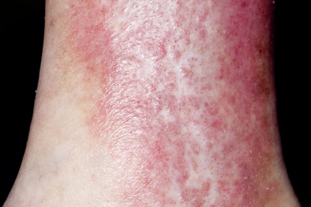 Varicose eczema - NHS.UK