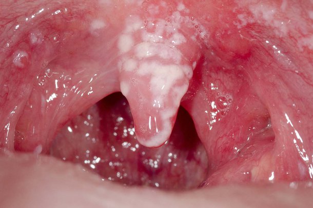 White patches inside mouth caused by oral thrush