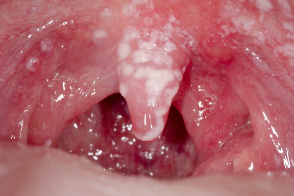 Your mouth is red inside and you have white patches. Image Credit: DR P. MARAZZI/SCIENCE PHOTO LIBRARY