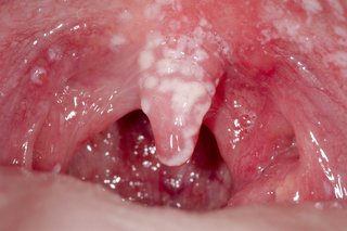 รอยสีขาวภายในปากที่เกิดจากเชื้อราในช่องปาก