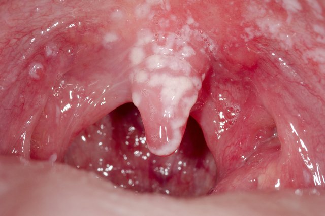 yeast in mouth symptoms