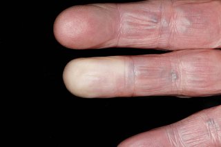 White fingers caused by Raynaud's