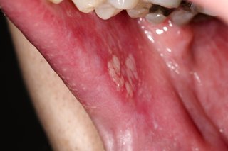 Bercak putih lichen planus di mulut.