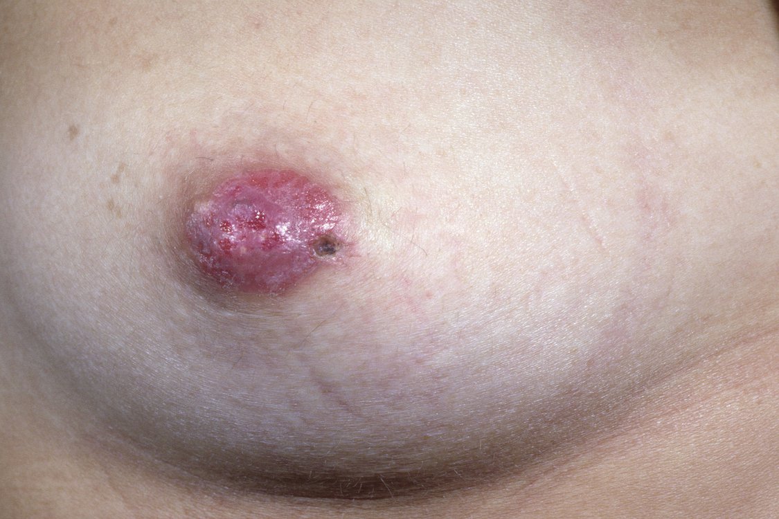 Nipples and breast cancer