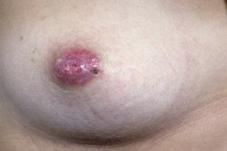 Gambar wanita dengan penyakit Paget pada puting