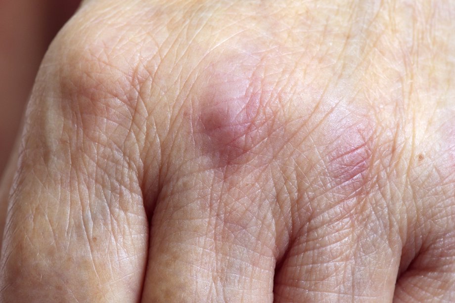 Picture of dermatomyositis rash