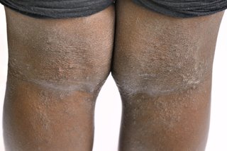 Picture of eczema on the back of the knees