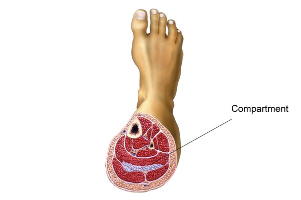 Picture of compartment syndrome