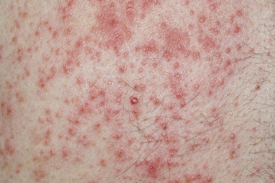 contact-dermatitis-nhs