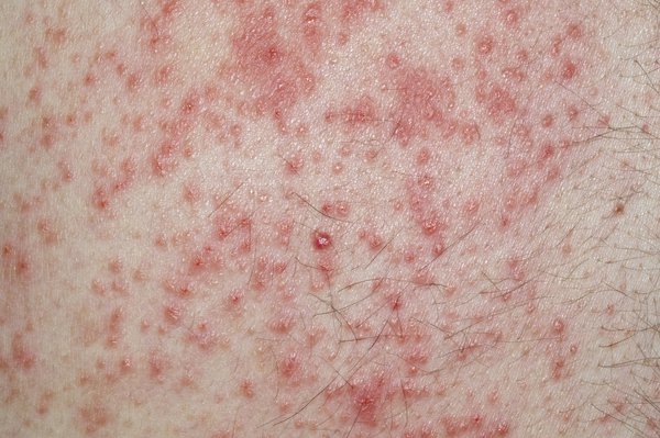 A sore rash of small red dots on white skin. Image Credit: DR P. MARAZZI/SCIENCE PHOTO LIBRARY