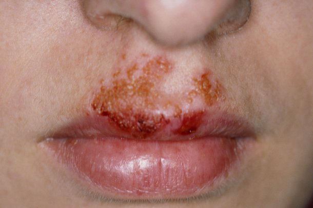 Picture of non-bullous impetigo rash