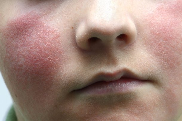 A slapped cheek syndrome rash on the face
