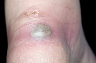 An infected blister full of green and yellow pus