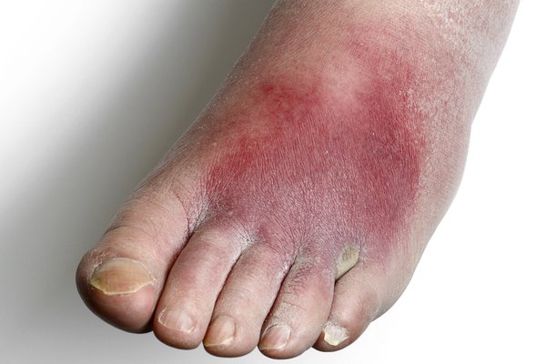 Feet – sometimes near toes if you have athlete's foot. Image Credit: SCIENCE PHOTO LIBRARY