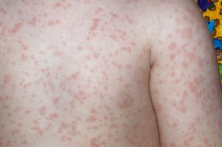 A slapped cheek syndrome rash on the body.