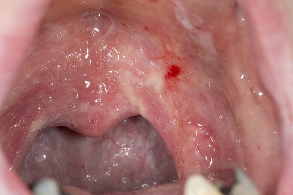 When you wipe off the white patches, they leave red spots that can bleed. Image Credit: DR P. MARAZZI/SCIENCE PHOTO LIBRARY