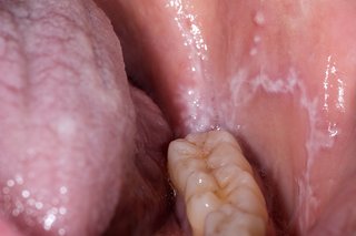 Mulut terbuka menunjukkan deretan gigi paling bawah, dengan bercak putih di lidah dan di dalam pipi