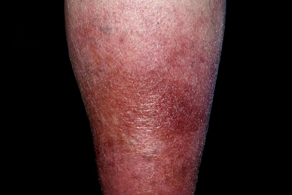 Legs – usually the lower legs. Image Credit: DR P. MARAZZI/SCIENCE PHOTO LIBRARY