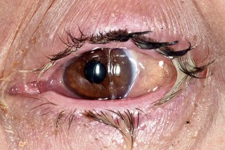 how long eye drops for conjunctivitis