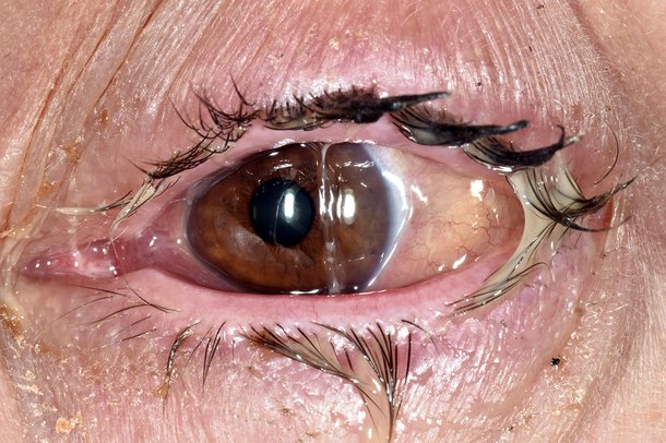 A sticky eye that is producing pus