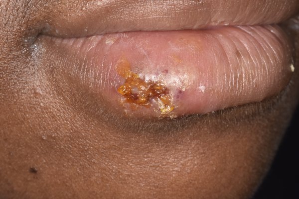 Burst cold sore on lower lip that has become a scab