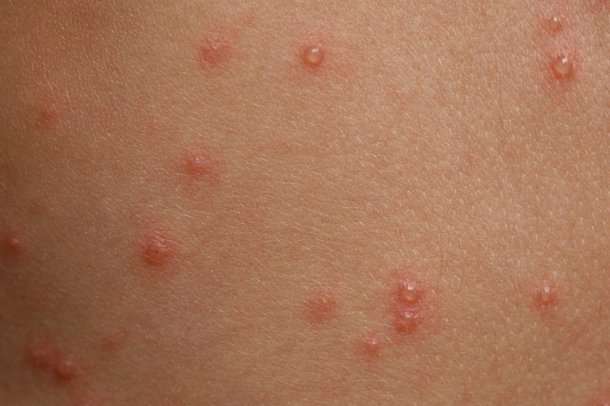 Chicken pox beginning stages