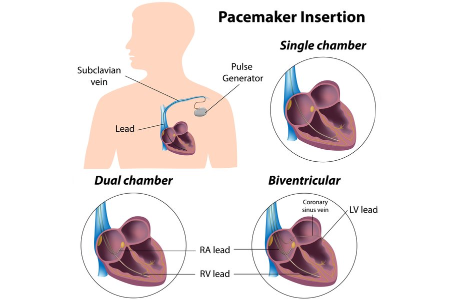 Single vs dual chamber pacemaker