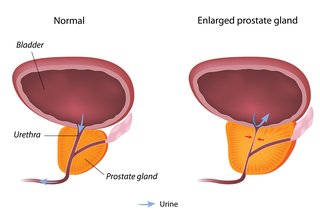 Diagram dari prostat normal dan prostat yang membesar.