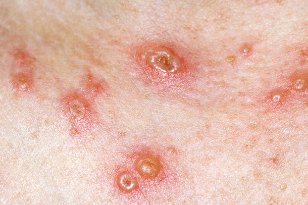 Picture of chicken pox