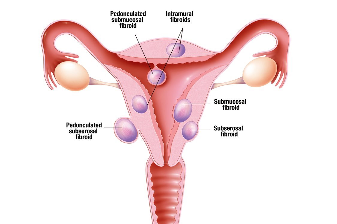 Diagram of different types of fibroids