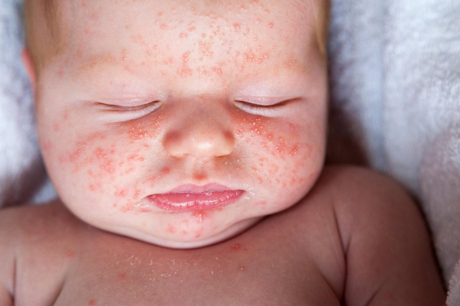 Red spotty rash on a baby's face