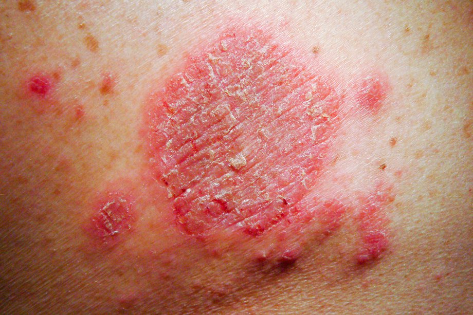 Discoid eczema - NHS.UK