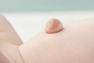 Gambar bayi dengan hernia umbilikalis